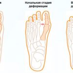 деформация стопы у взрослых